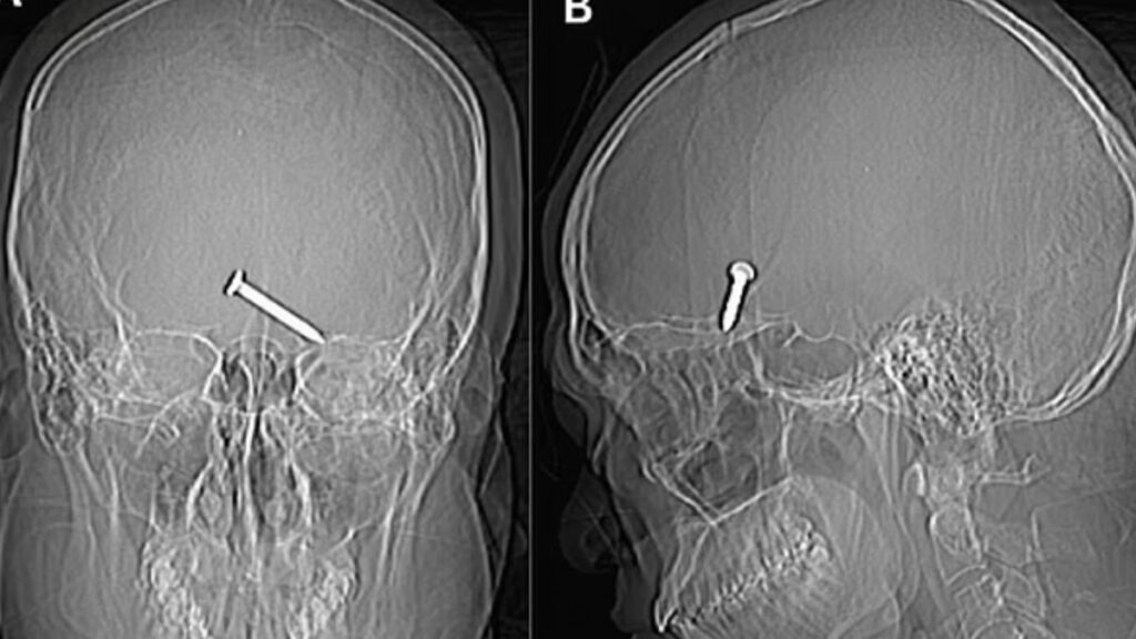 Hombre sobrevivió después de dispararse accidentalmente con una pistola de clavos en el cerebro