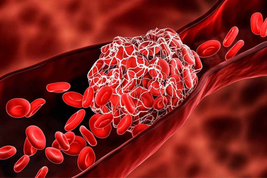 Qué es la trombosis, el efecto de la vacuna de AstraZeneca 