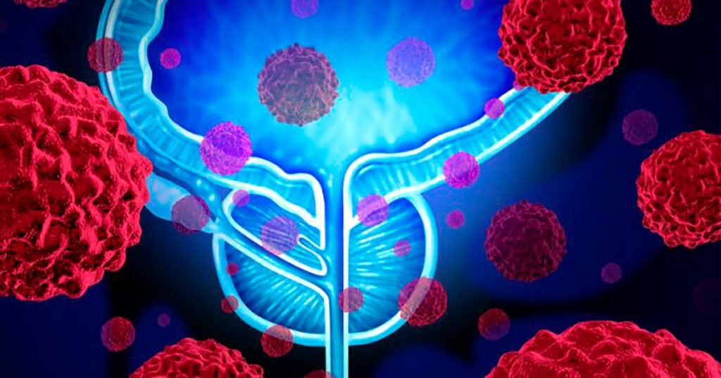 Identifican genes clave que permiten predecir la evolución del cáncer de próstata