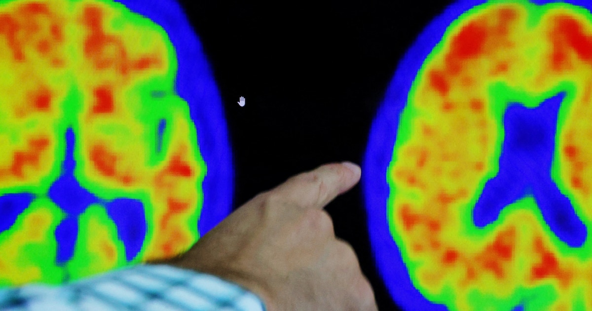 Los primeros síntomas de demencia temprana incluyen dos cambios notables, no solo pérdida de memoria