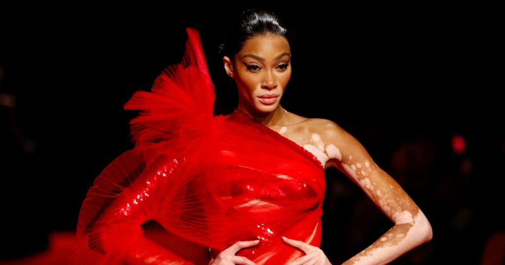 Día Mundial del Vitiligo: la inspiradora historia de la modelo que es un emblema de resiliencia