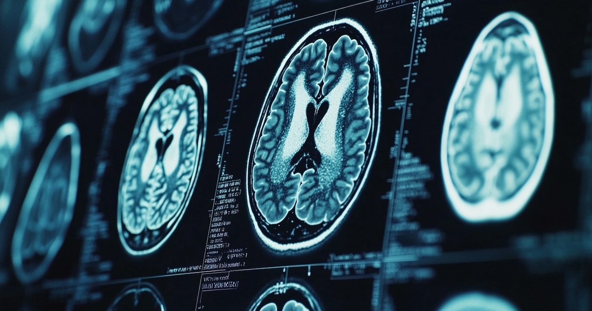 Cómo funciona la inteligencia artificial que puede detectar Alzheimer y otras demencias con una sola imagen