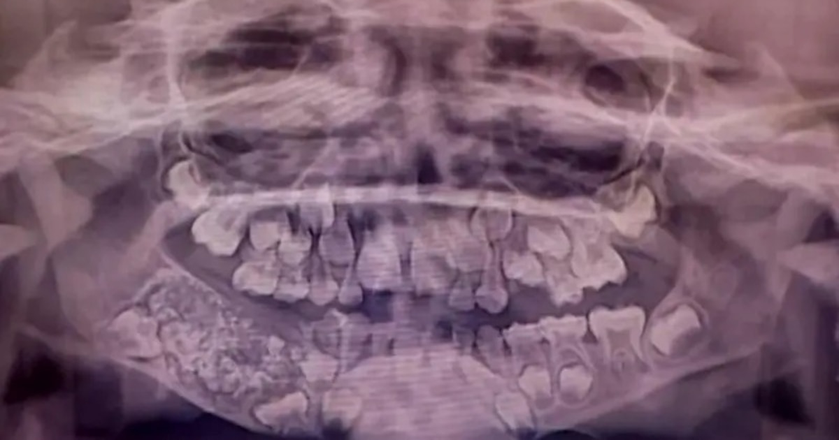 Niño recibe cirugía y le extraen 526 dientes en un único procedimiento