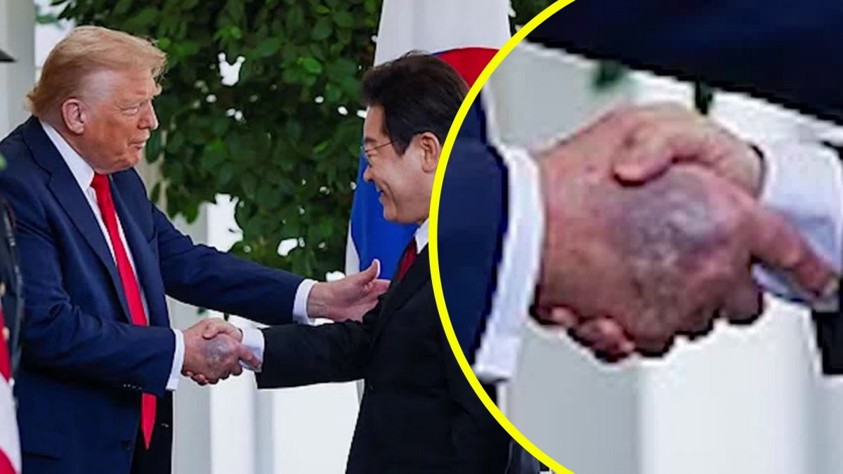 ¡Impactante! Preocupa la salud de Trump a los 79 años por hematomas en sus manos y misteriosos síntomas que generan alarma en EE.UU.