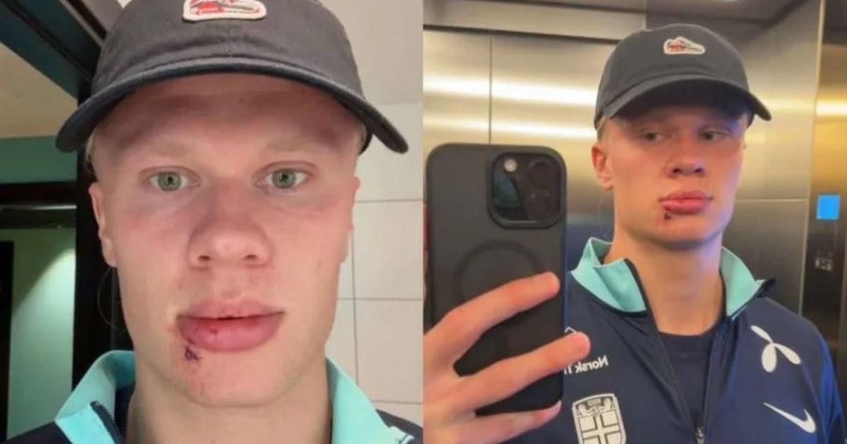 Haaland sufre brutal accidente en concentración de Noruega y necesita puntos de sutura antes del duelo clave
