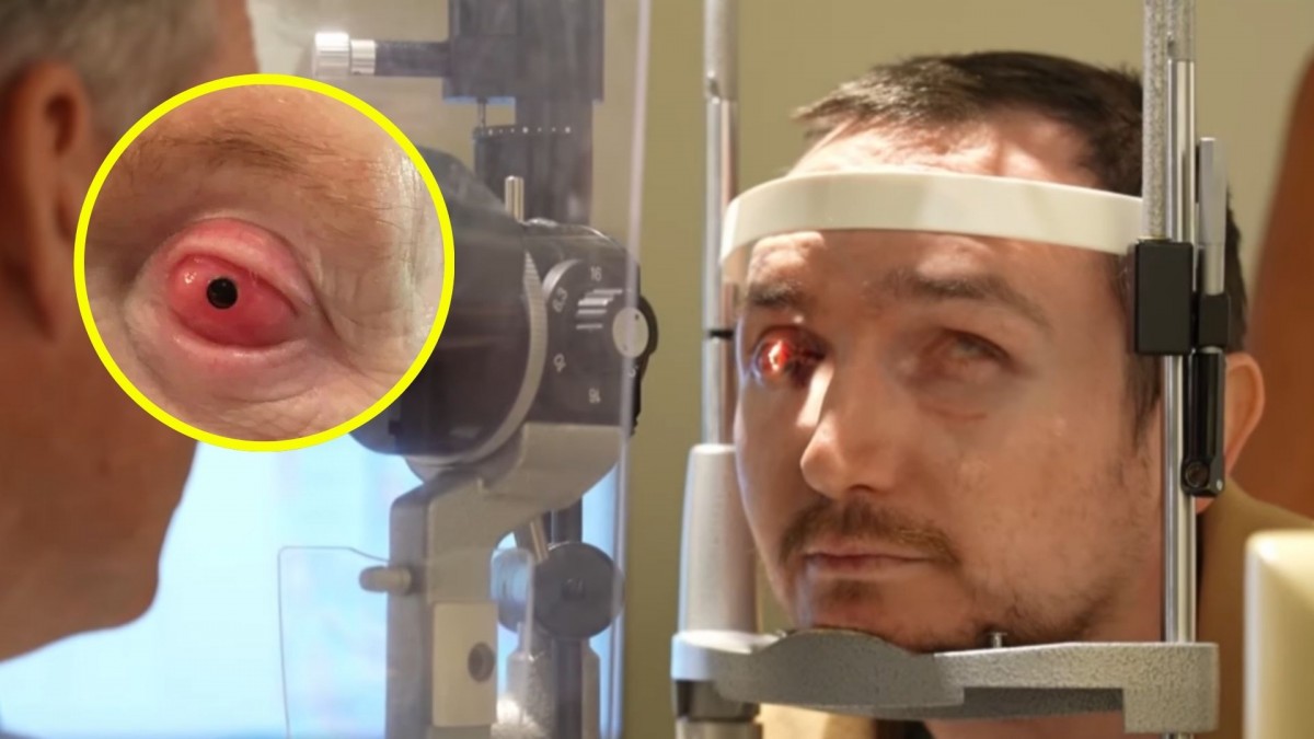 ¡Increíble! Hombre ciego de Vancouver recupera la vista tras revolucionario implante dental en el ojo