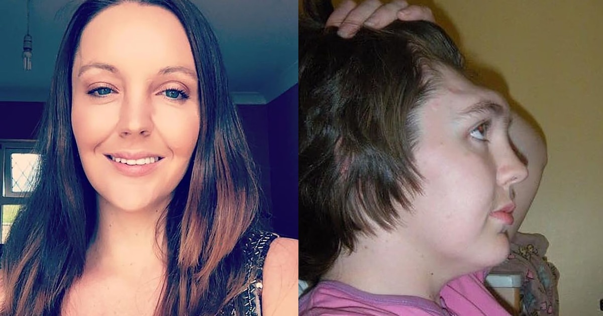 Impactante reconstrucción facial de Kealy tras perder su frente en accidente vial y la advertencia sobre los riesgos de viajar con los pies en el tablero