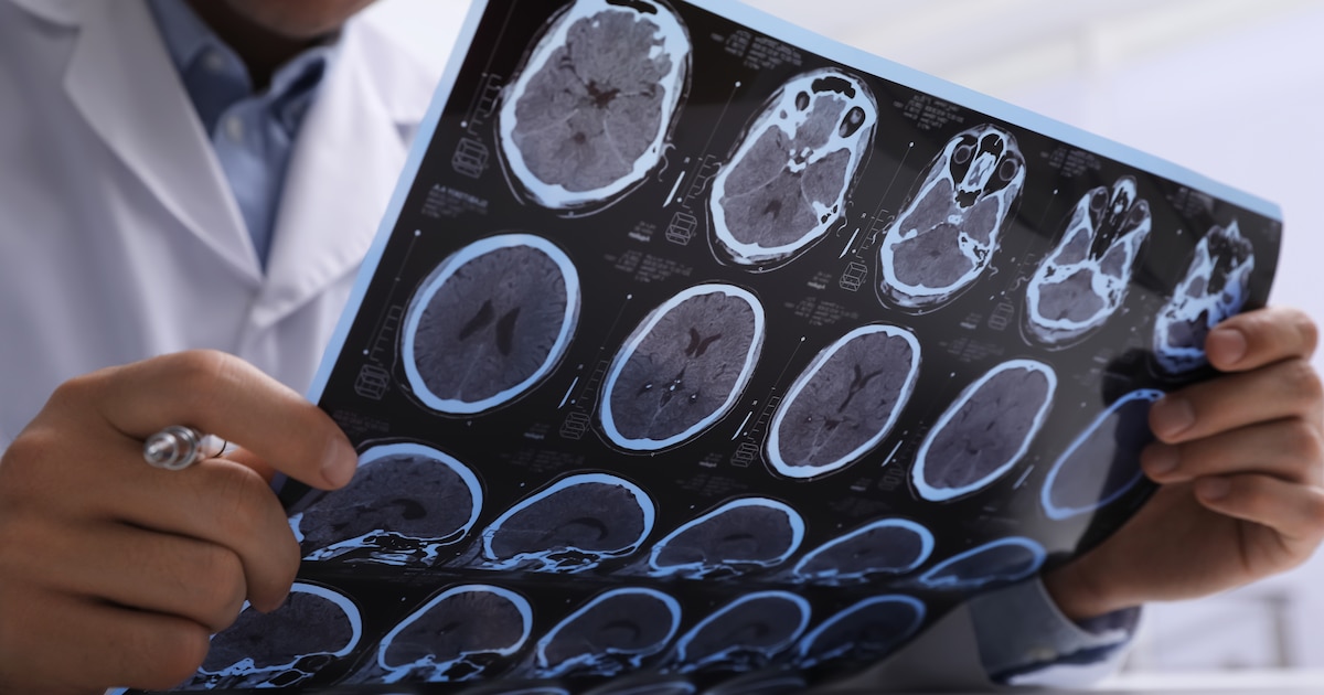 Señales clave del Alzheimer en Perú: cómo detectar esta enfermedad temprano