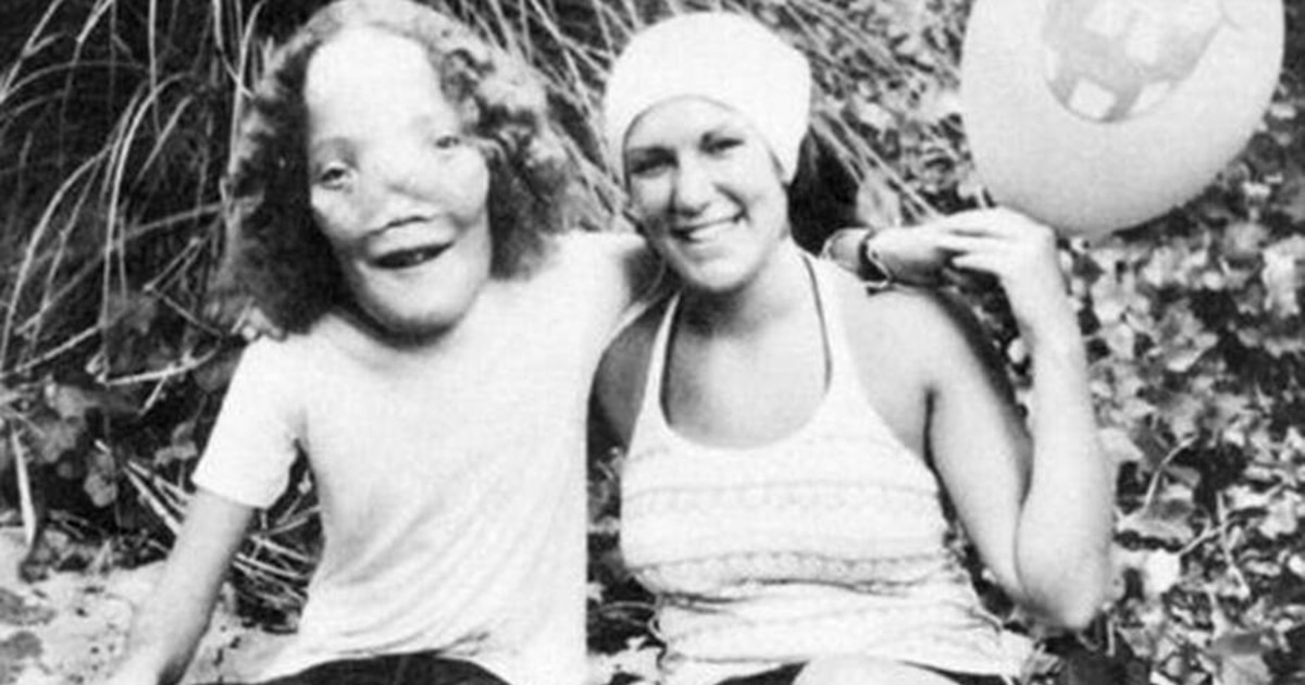 Ni la cruel displasia craneofacial detuvo a Rocky Dennis: un símbolo de coraje y resistencia en los 80