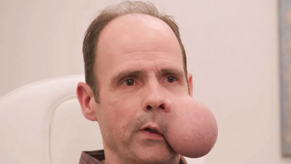 ¡Hombre con tumor de 2 kilos en la cara enfrenta operación radical que podría ser su sentencia de muerte!