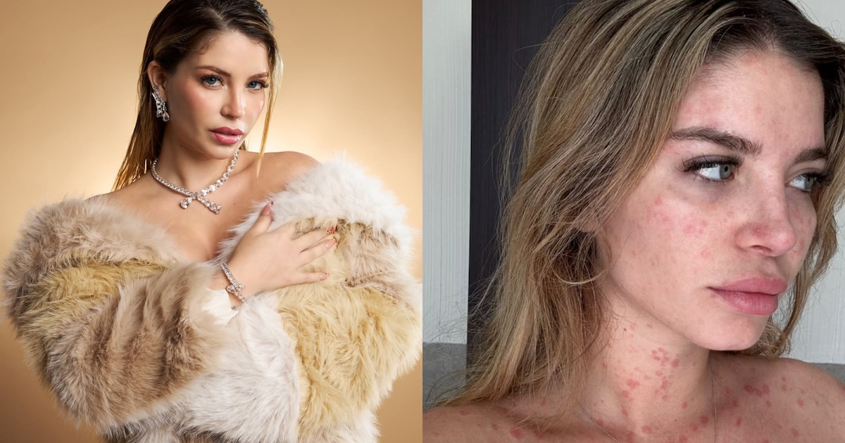 Flavia Laos comparte su experiencia con la psoriasis y promueve la empatía