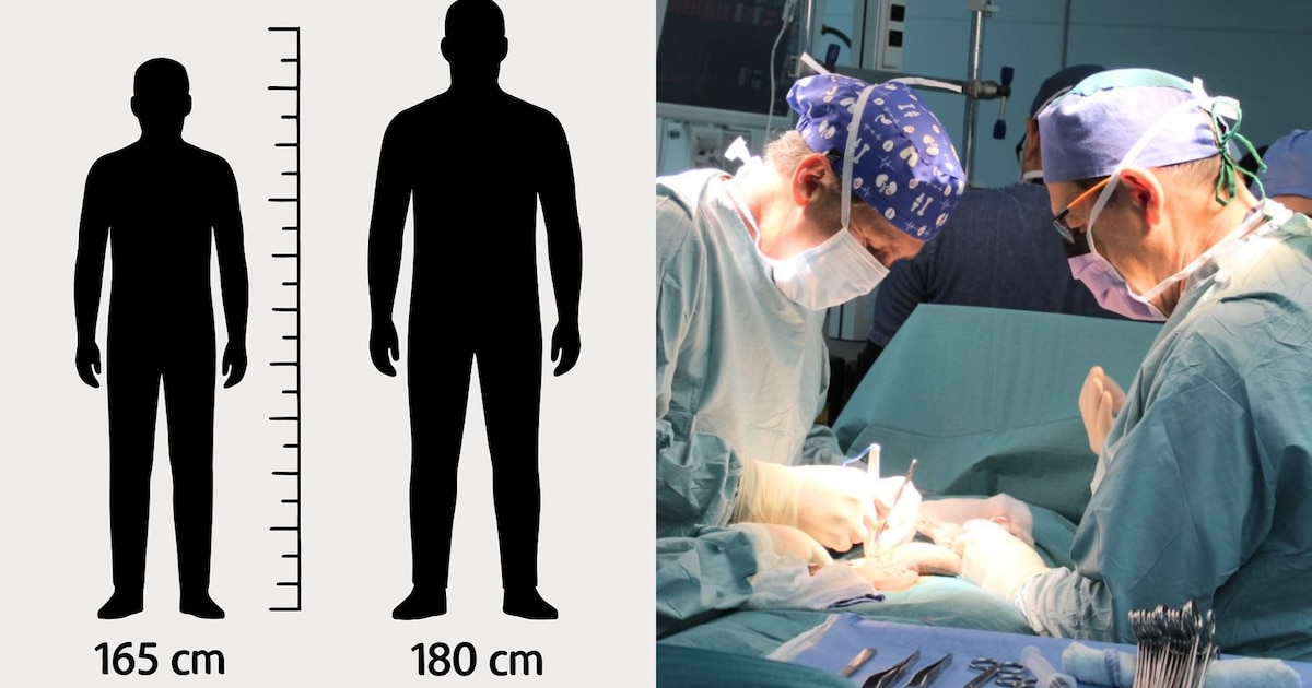 Peruanos buscan aumentar su estatura tras promediar 165 cm, con costosas cirugías