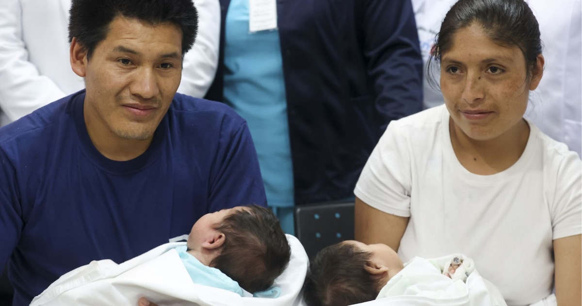 Éxito en Navidad: médicos separan con éxito a gemelas siamesas unidas por la columna en INSN San Borja